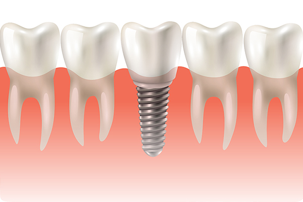 Zahnärztin DDr. Reimer Agnes, Implantologie Zahnärztin DDr. Reimer Agnes, Implantologie
